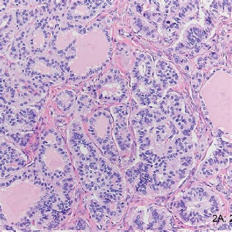 a. Neuroendocrine tumor cells predominantly arranged in nests and ...