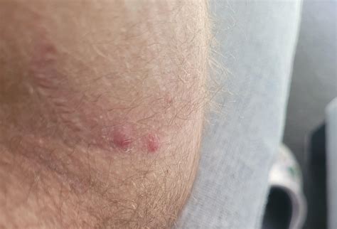 Pimple Like Around Bum From Cycling R Dermatologyquestions