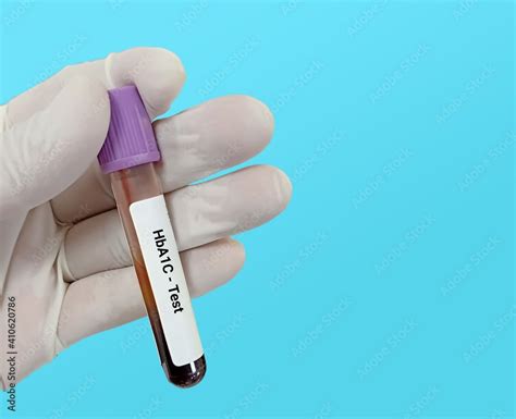 Biochemist Or Lab Technologist Holds Blood Sample For HbA1c Hemoglobin