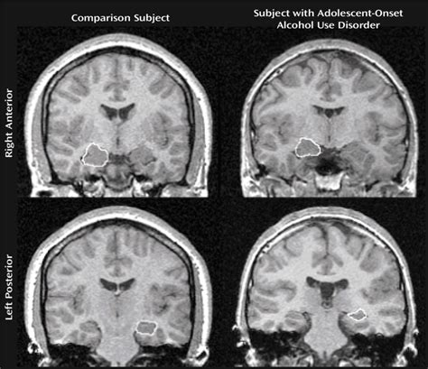 Hippocampus Brain Mri