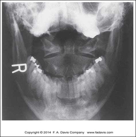 Spine Imaging Flashcards Quizlet