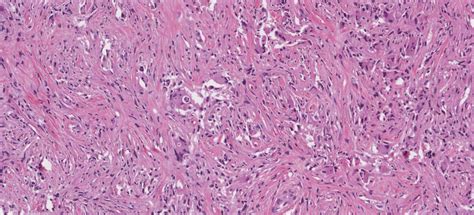 Rosai Dorfman Disease Ottawa Atlas Of Pathology