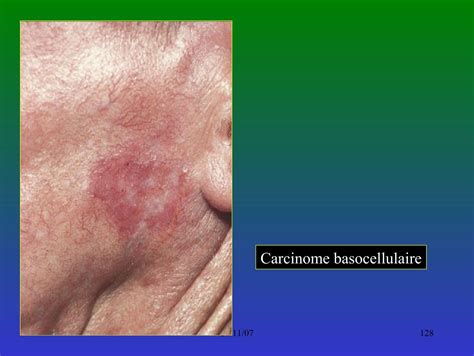 Carcinome Basocellulaire