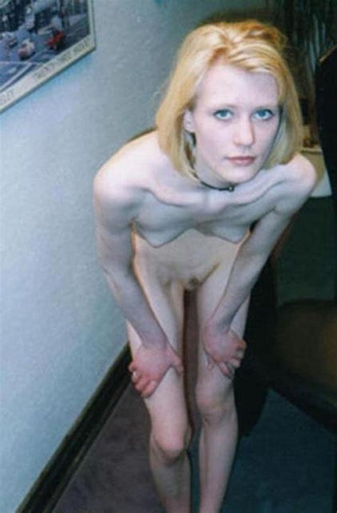 Anorexic Woman Nude Xsexpics