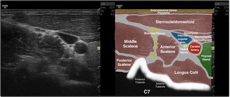 A Procedure For Measuring Anterior Scalene Morphology And Quality With