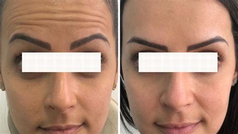 Botox antes e depois conheça o resultado da transformação e seu benefício