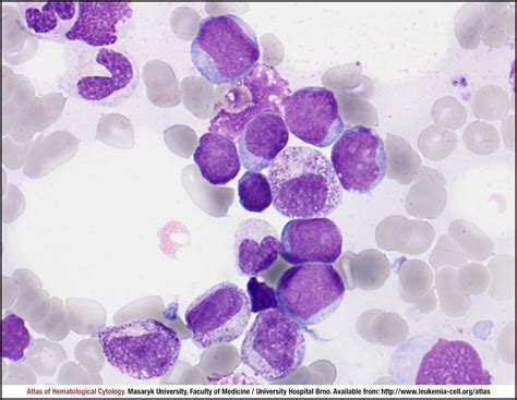 Centroblastic Morphological Variant Cell Atlas Of Haematological