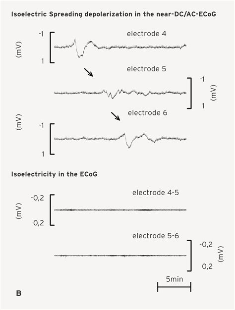 Spreading Depolarization And Spreading Ischemia Braintsunamis