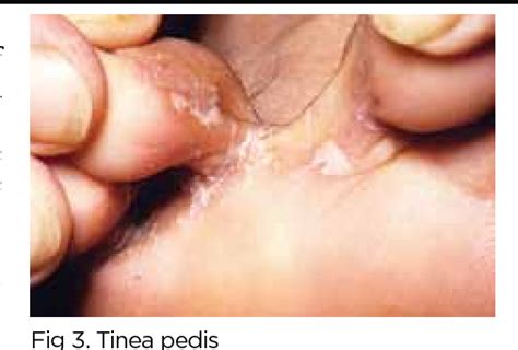 Figure 3 From Diagnosing Assessing And Treating Cellulitis The Importance Of Differential