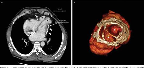 Figure From Localized Constrictive Pericarditis Resulting In