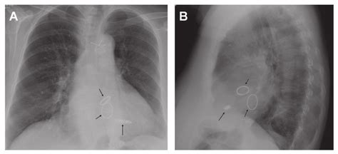 Chest X Ray Of The Patient Panel A Posteroanterior View Panel B