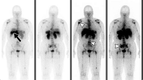 Imaging Features Of Carcinoid Tumors Of The Gastrointestinal Tract Ajr