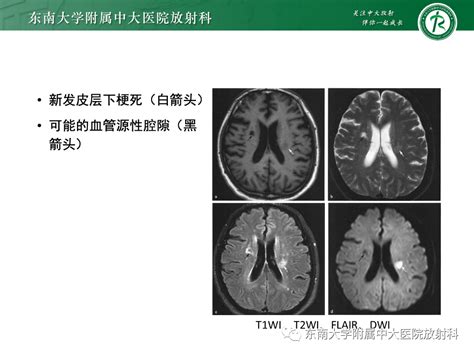 脑小血管病的影像表现高血压腔隙性脑梗塞放射科血管影像 健康界