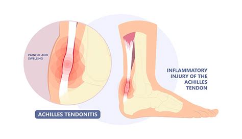 Achilles tendonitis treatment - HOMED