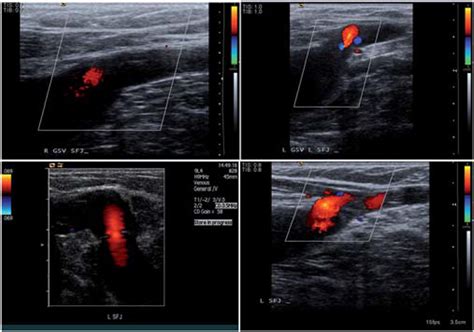 Duplex Ultrasound In The Assessment Of Lower Extremity Venous