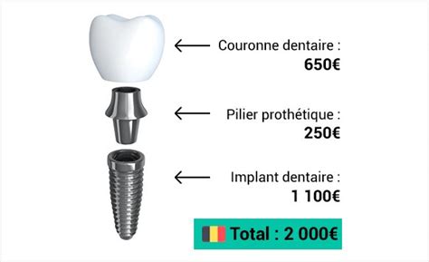 Prix Implant Dentaire Complet Les Tarifs Moyens En