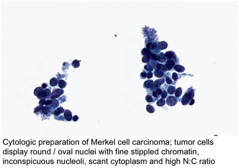 Pathology Outlines Merkel Cell Carcinoma