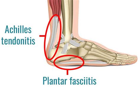 Plantar Fasciitis And Achilles Tendonitis Treatment Hot Sale