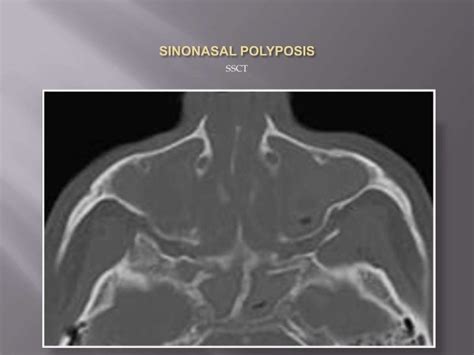 Sinonasal Polyposis