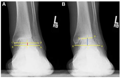 Whats New In Podiatry Journal Article Summary Assessing The Ankle