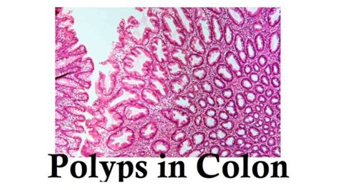 Polyps In Colon: 4 Types, Symptoms, And Causes » 2024