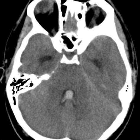 Brain Aneurysm Ct Scan - Diagnosis of a brain aneurysm may require ct ...