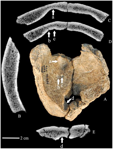 The Xujiayao 11 Parietal Bones Interior View A Ct Sagittal Section Download Scientific