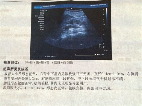 肾结石4 6mm该怎么办 肾结石6mm排出的方法是