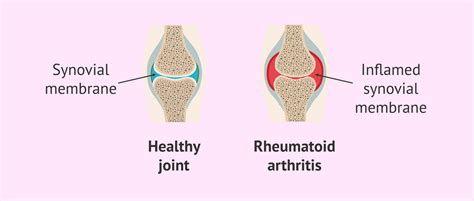 Can I Get Pregnant If I Am Diagnosed With Rheumatoid Arthritis