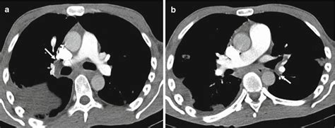 Embolism Radiology Key