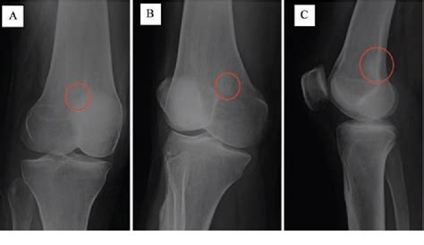 Figure 1 From Periosteal Osteoid Osteoma Of The Distal Femur Semantic