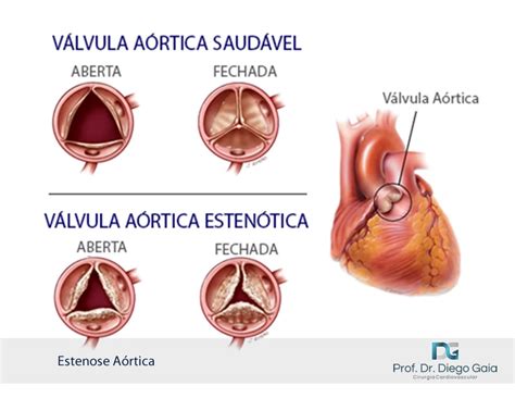 Tratamento Transcateter da válvula aórtica