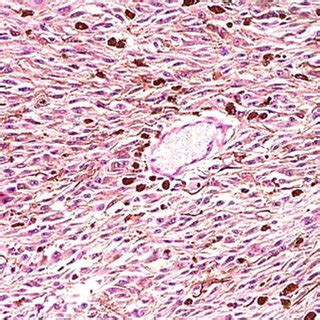 -Spindle cell uveal melanoma: small and medium fusiform cells and... | Download Scientific Diagram