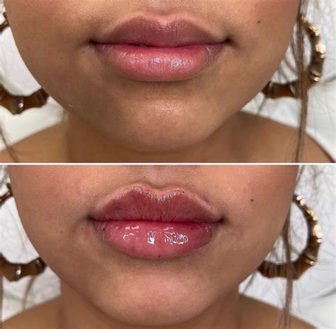 Lip Filler Full Syringe The Flawless Lab Scottsdale Arizona