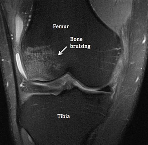 Bone Bruise - Causes, Symptoms, Diagnosis, Treatment & Healing Time