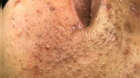 Acne Vulgaris Blackheads Youtube