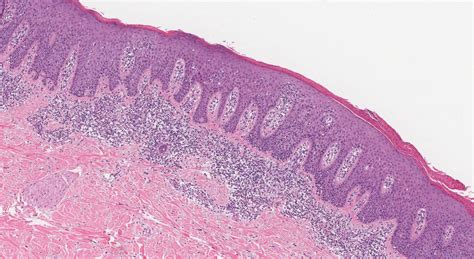 Mycosis fungoides | Ottawa Atlas of Pathology