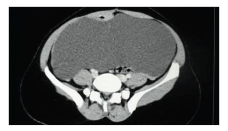 Appearance of large mesenteric cyst on abdominal CT. | Download Scientific Diagram