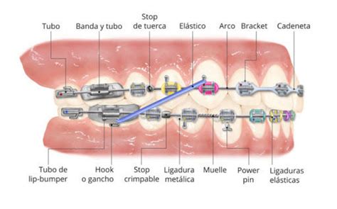 Tecnicas De Ortodoncia Mapa Mental