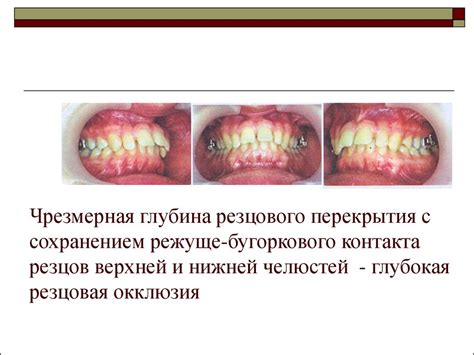 Глубокий прикус - презентация онлайн