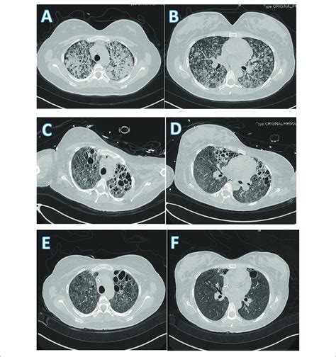 Image Of Chest Ct Scan A B Chest Ct On Admission Showed Multiple