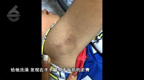 昆明5岁男童被幼儿园老师掐得青一块紫一块！出现中度抑郁，甚至自残腾讯新闻