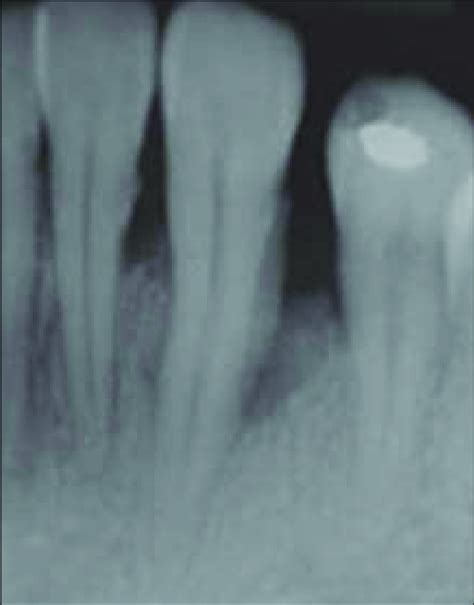 A Preoperative Radiographic View Showing A Vertical Bone Defect In A