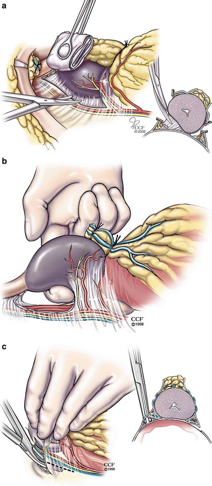 Open Radical Retropubic Prostatectomy And Pelvic Lymph Node Dissection