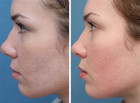 Co2 Laser Treatment For Acne Scars Cost In India At Thomas Villarreal Blog