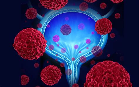 Fda Approves Immunotherapy Drug For Advanced Bladder Cancer Md Anderson Cancer Center