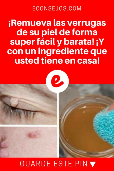 Remueve las verrugas de tu piel de forma fácil y barata El