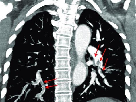 Coronal Section Ctpa Shows Extensive Pulmonary Emboli In Segmental And