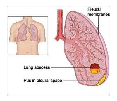 Lung Abscess - Standard Treatment Guidelines - Medical Dialogues