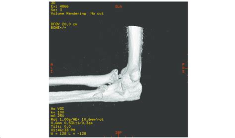 Computed tomography (three-dimensional reconstruction) | Download ... 